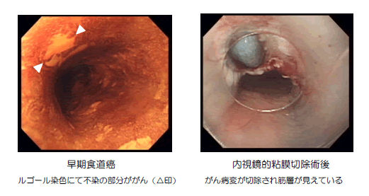 食道 が ん 初期 症状